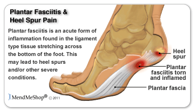 plantar-fasciitis-heel-spur-injury